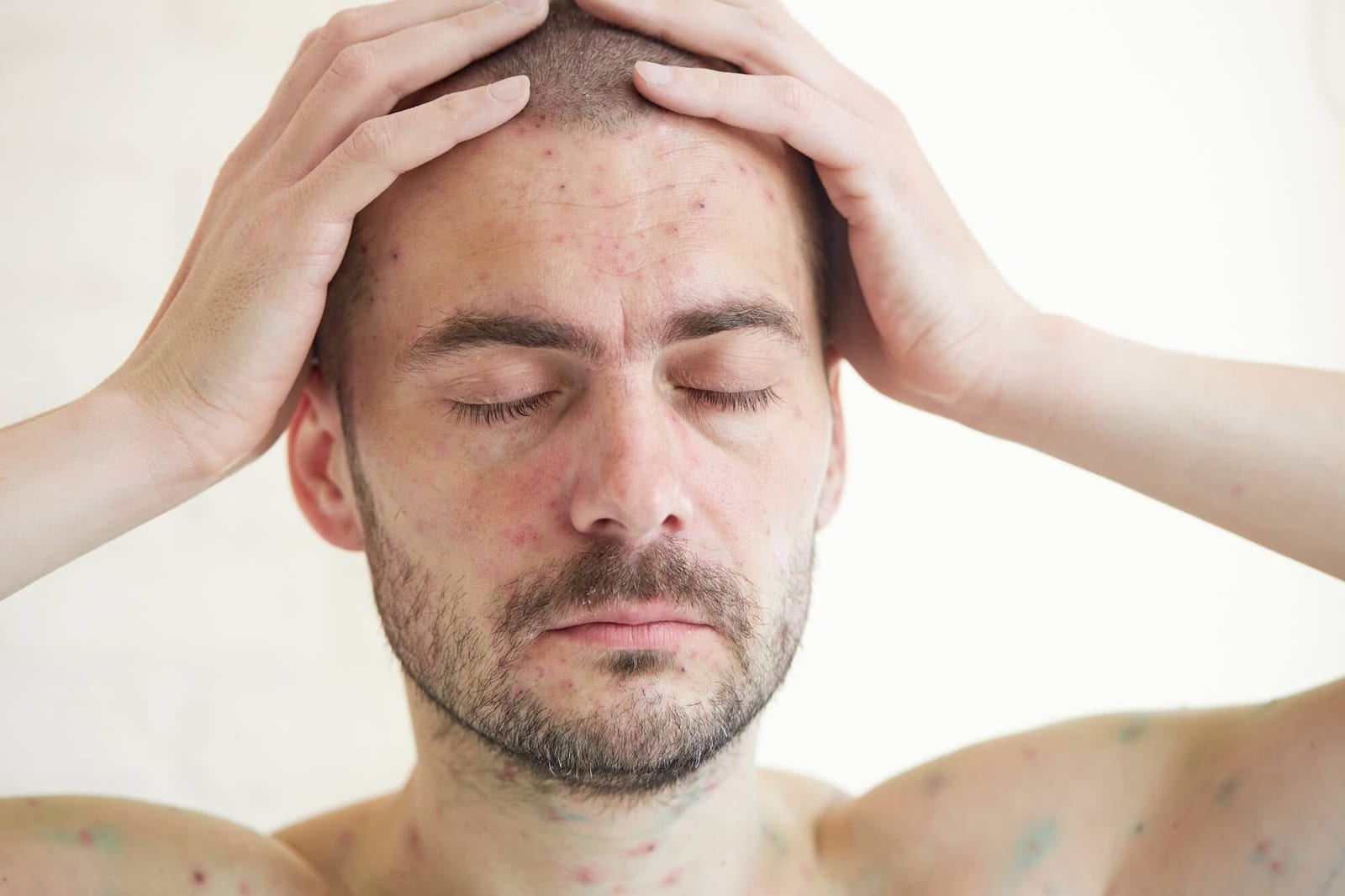Body of adult man have spotted, red pimple and bubble rash from chickenpox or varicella zoster virus. Medical complications after illness. Treatment with brilliant green