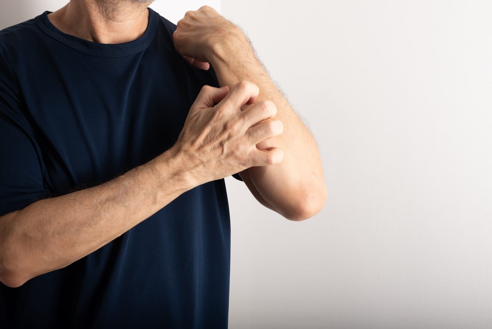 Middle-aged man scratching his forearm. Skin disease. Dermatological care